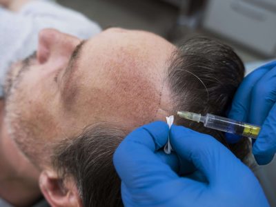 How Long Does It Take for Hair Transplant Treatment?
