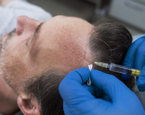 hair-transplant