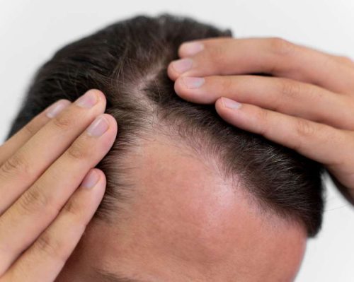Hair Transplant Procedure