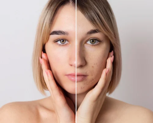 hydrafacial before and after in chennai