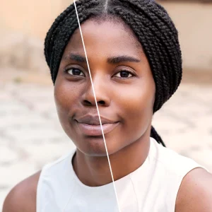 Hyperpigmentation Chemical Peel Before and After Results