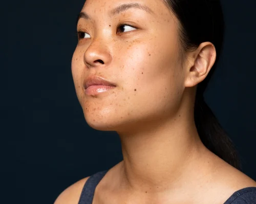 Hyperpigmentation Chemical Peel Before and After Results