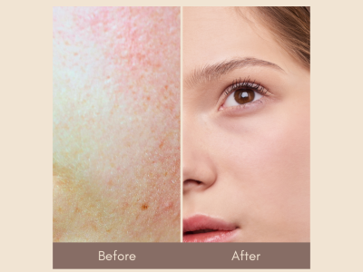 laser toning treatment in chennai