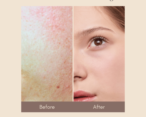 Laser Toning for Face