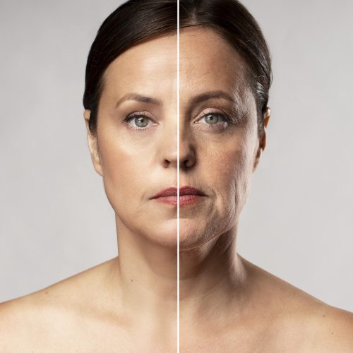 laser_toning_before&after_dermiscare