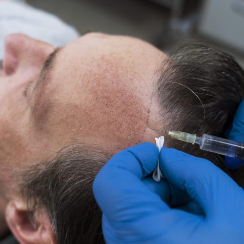 man-getting-hair-loss-treatment