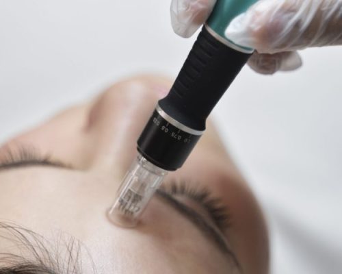 micro-needling-mnrf-treatment_dermiscare-scaled - dermisecare