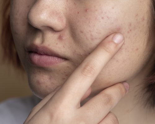 skin-pores-dermiscare-porur &kilpauk